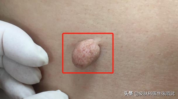 皮肤上长小肉球,身体上长小肉粒能用头发去掉吗