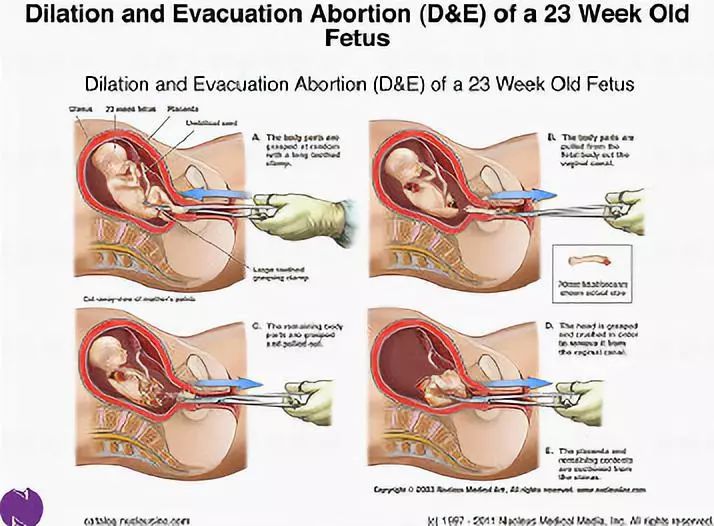 27岁未婚女孩6年做了17次人流：无痛人流，没你想得那么简单