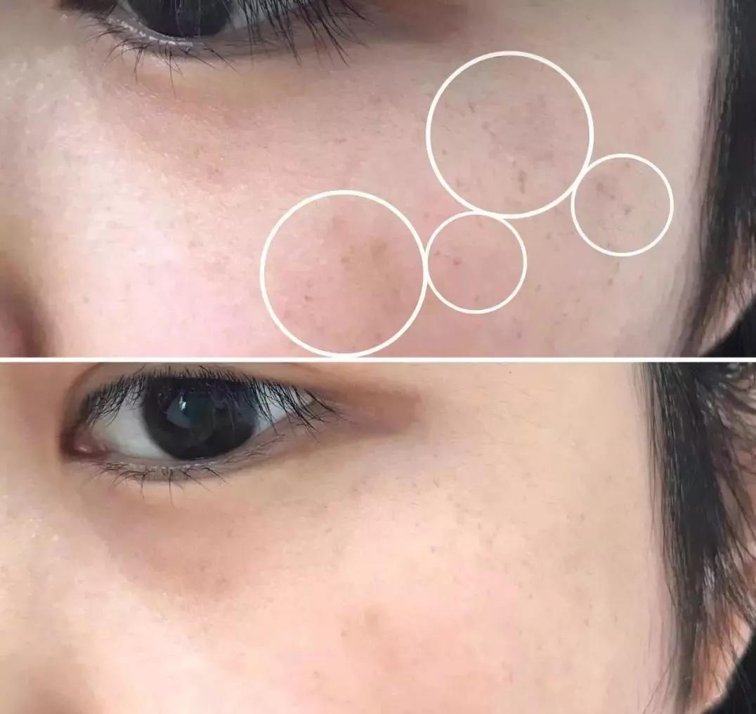 祛脸上斑点色斑的小妙招,一个动作教你如何淡化色斑