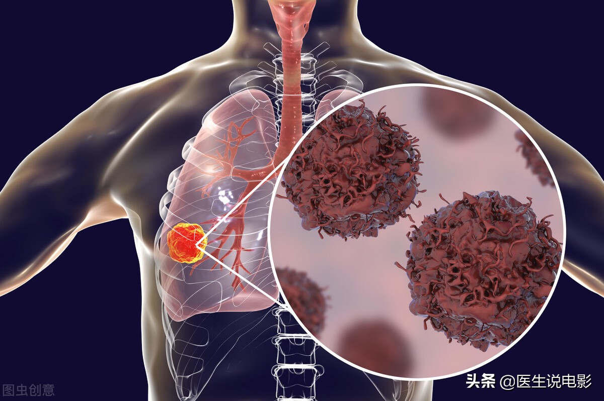 良性肿瘤有什么危害吗,良性肿瘤对机体的影响主要取决于