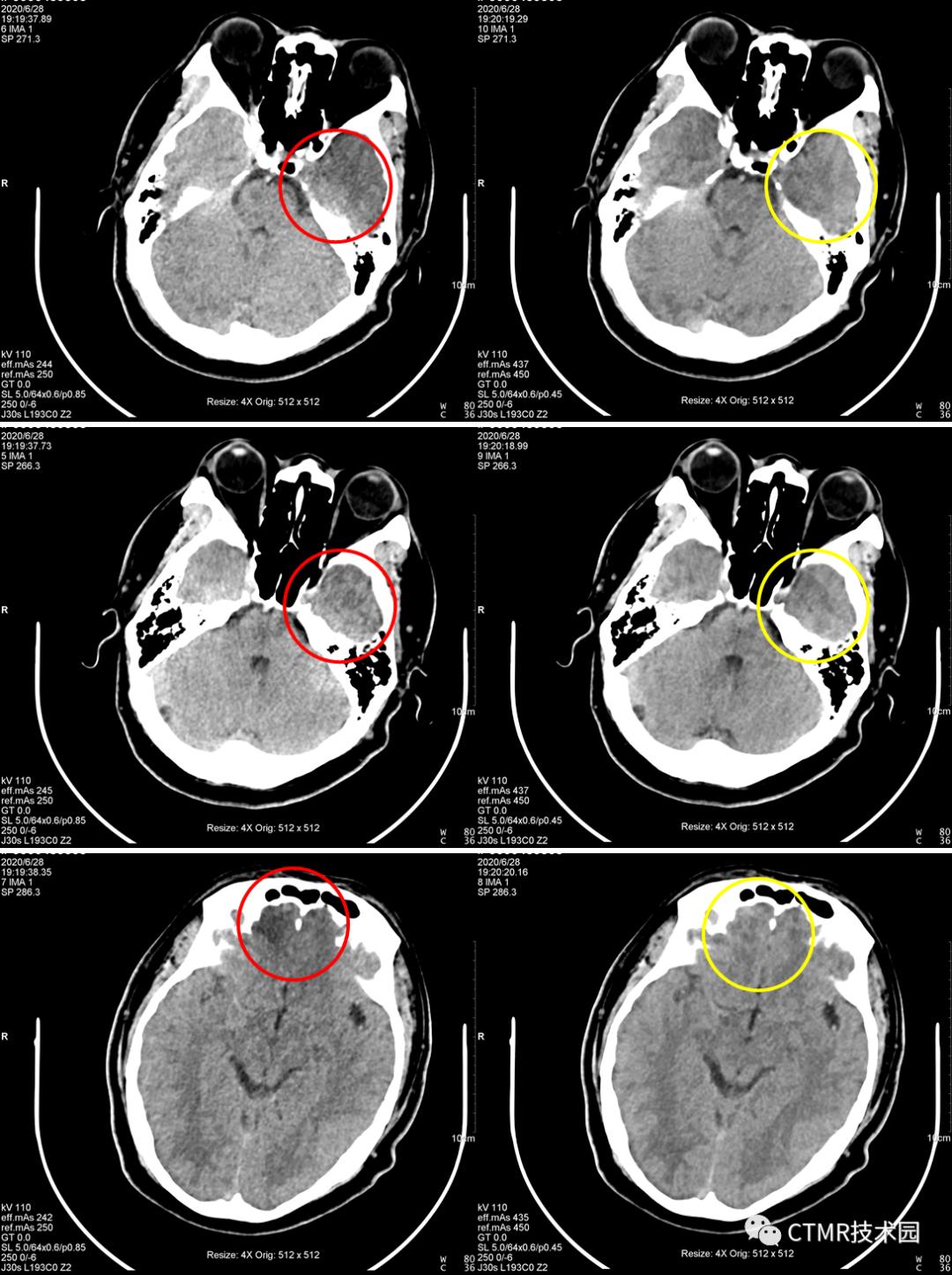 CT影像技术,脑部做ct有伪影是怎么回事