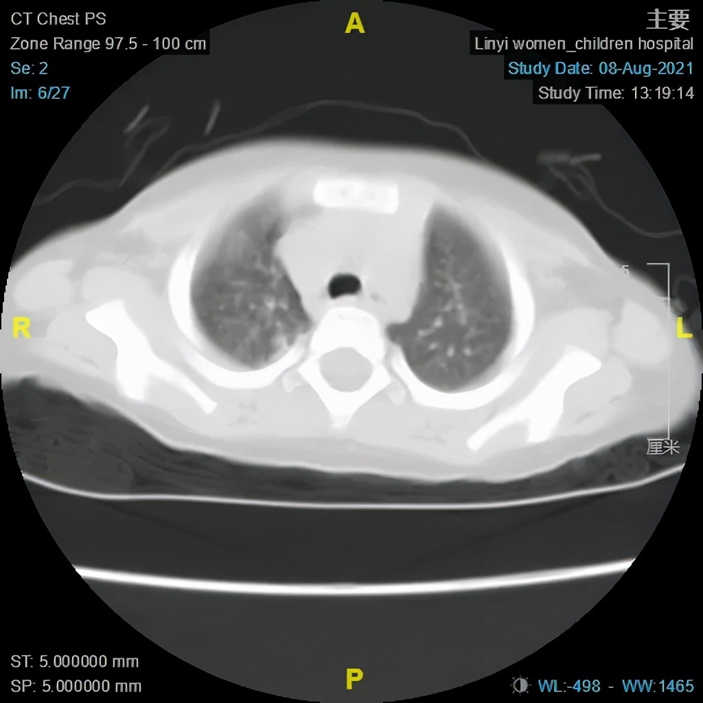 肺炎支气管镜一般费用多少,肺炎不好反复发烧