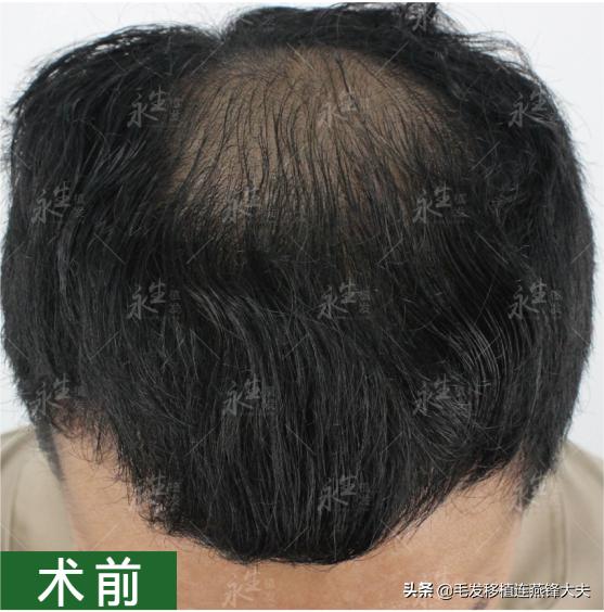 22岁得了脂溢性脱发,22岁脂溢性脱发还有救吗