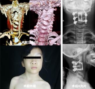 12岁女孩脖子歪了怎么办,11岁女童脖子颈椎都弯了怎么治疗