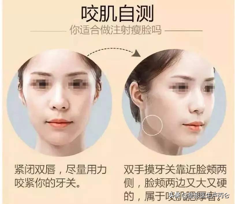 肉毒素瘦咬肌是让咬肌空隙变小吗,肉毒素注射后咬肌突出怎么办