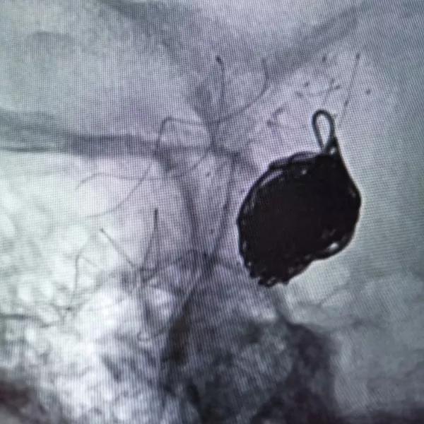山东大学齐鲁医院王东海教授团队成功治疗多发性动脉瘤