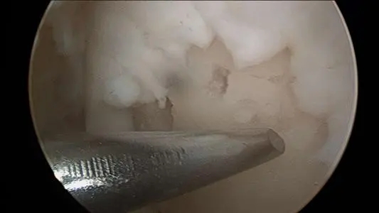 倒着走对膝盖有没有好处,倒着下楼梯对身体有好处吗