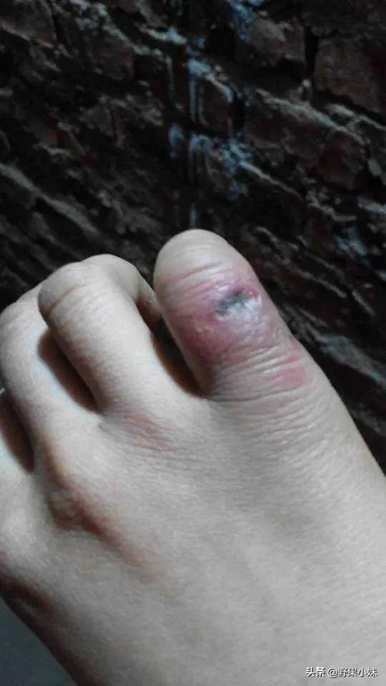 冻疮是怎么形成的原因是什么,冻疮严重溃烂的怎么治