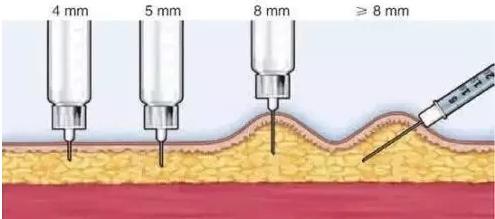 打皮下针拔针出血怎么办,皮下注射有回血继续注射会死吗