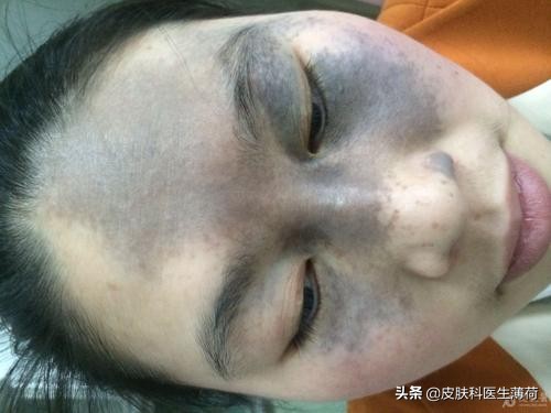 中药点斑好还是激光祛斑好,脸上有斑打激光过后吃有讲究吗