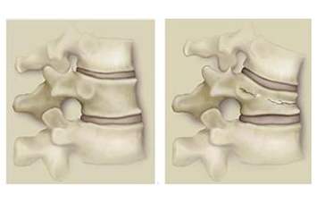腰痛只知道椎间盘突出？那就有点out了