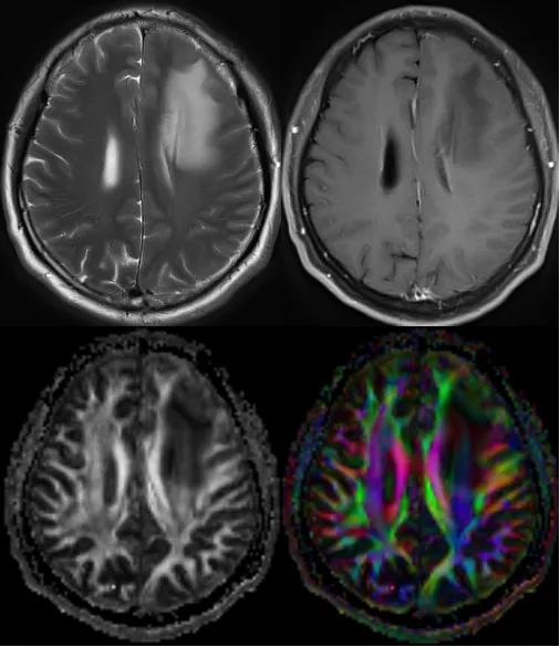 磁共振dti融合成像,磁共振dti成像作用