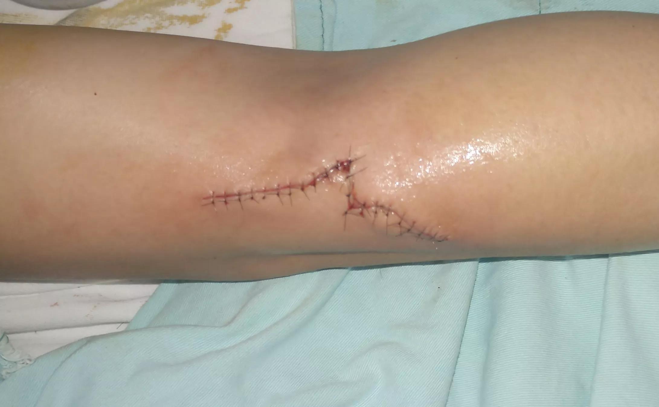 伤口美容缝合跟普通缝合比较图,皮肤缝合的手法