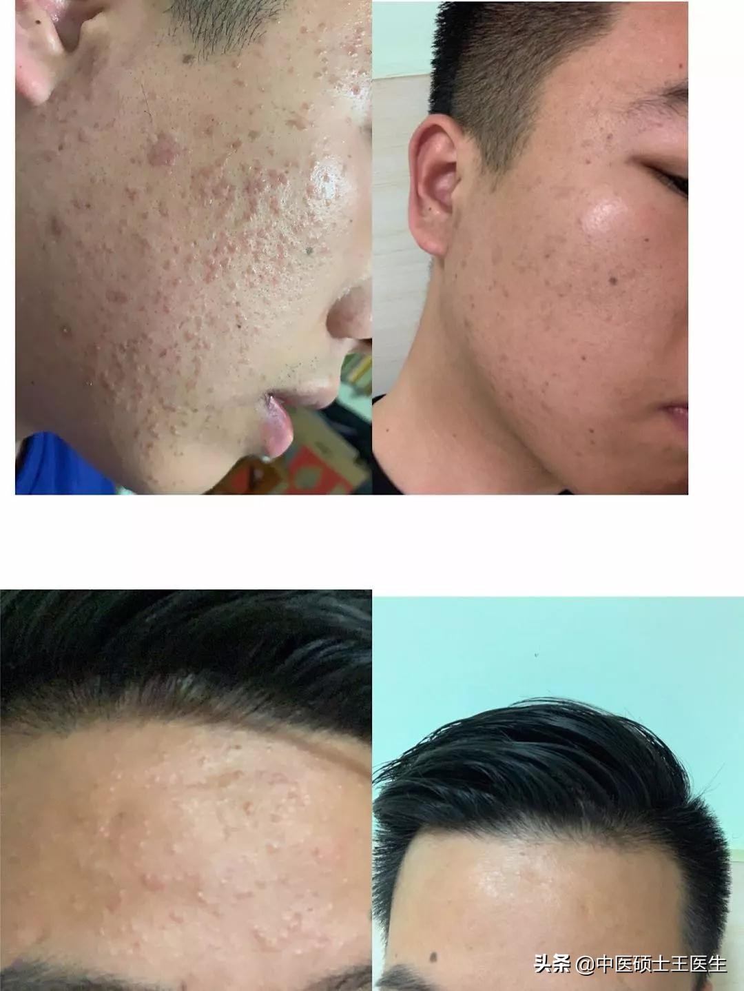 中医祛痘多少钱,中医祛痘挂什么科