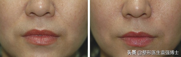 这3种方法解决法令纹效果很惊艳,最有效改善法令纹的方法