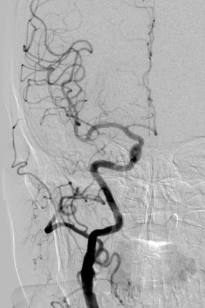 Tubridge®治疗多发性动脉瘤