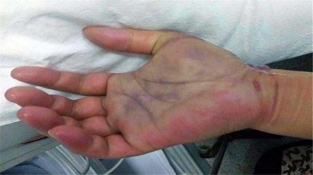 鱼刺扎伤手后感染的是什么菌,干鱼刺扎破手会感染细菌吗