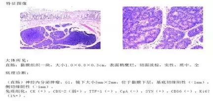 直肠神经内分泌肿瘤分级和治疗,直肠神经内分泌肿瘤到底是不是癌