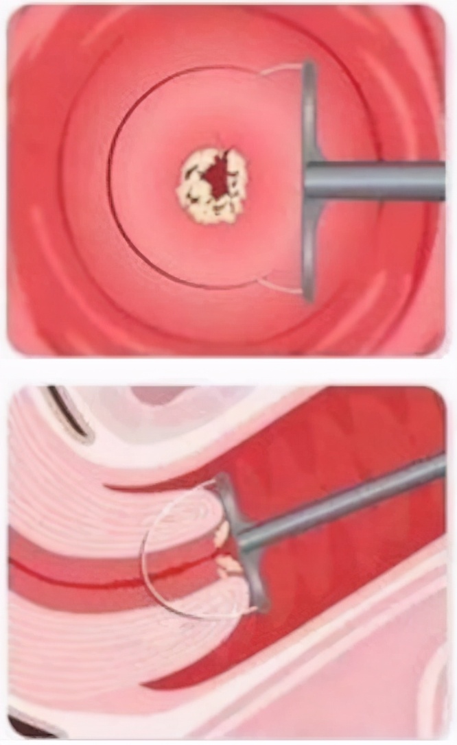 持续感染高危hpv用干扰素能转阴吗,hpv持续感染但是tct正常怎么办