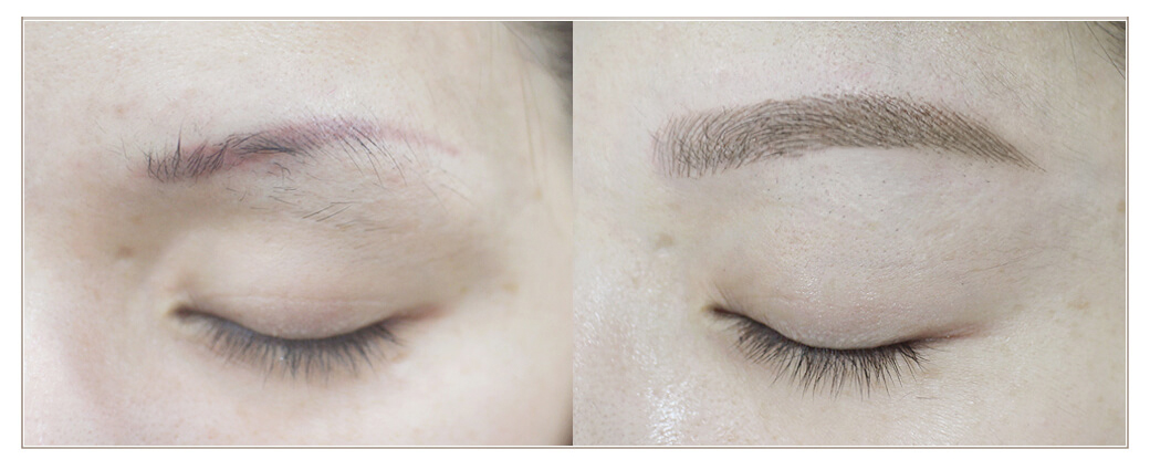 激光洗红眉的操作方法视频,红眉能激光吗