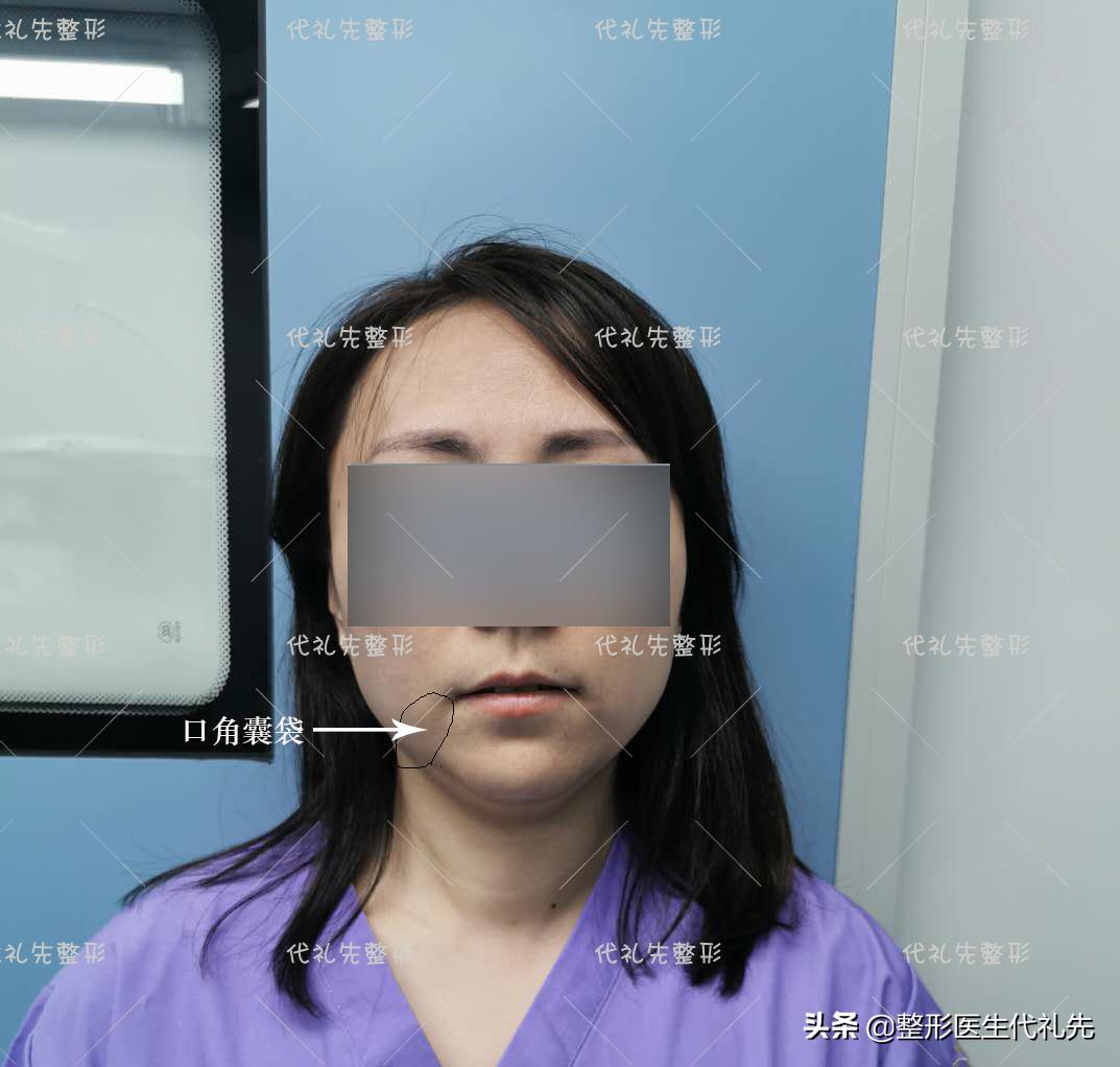 口角囊袋是整形后遗症么,去除口角囊袋恢复过程