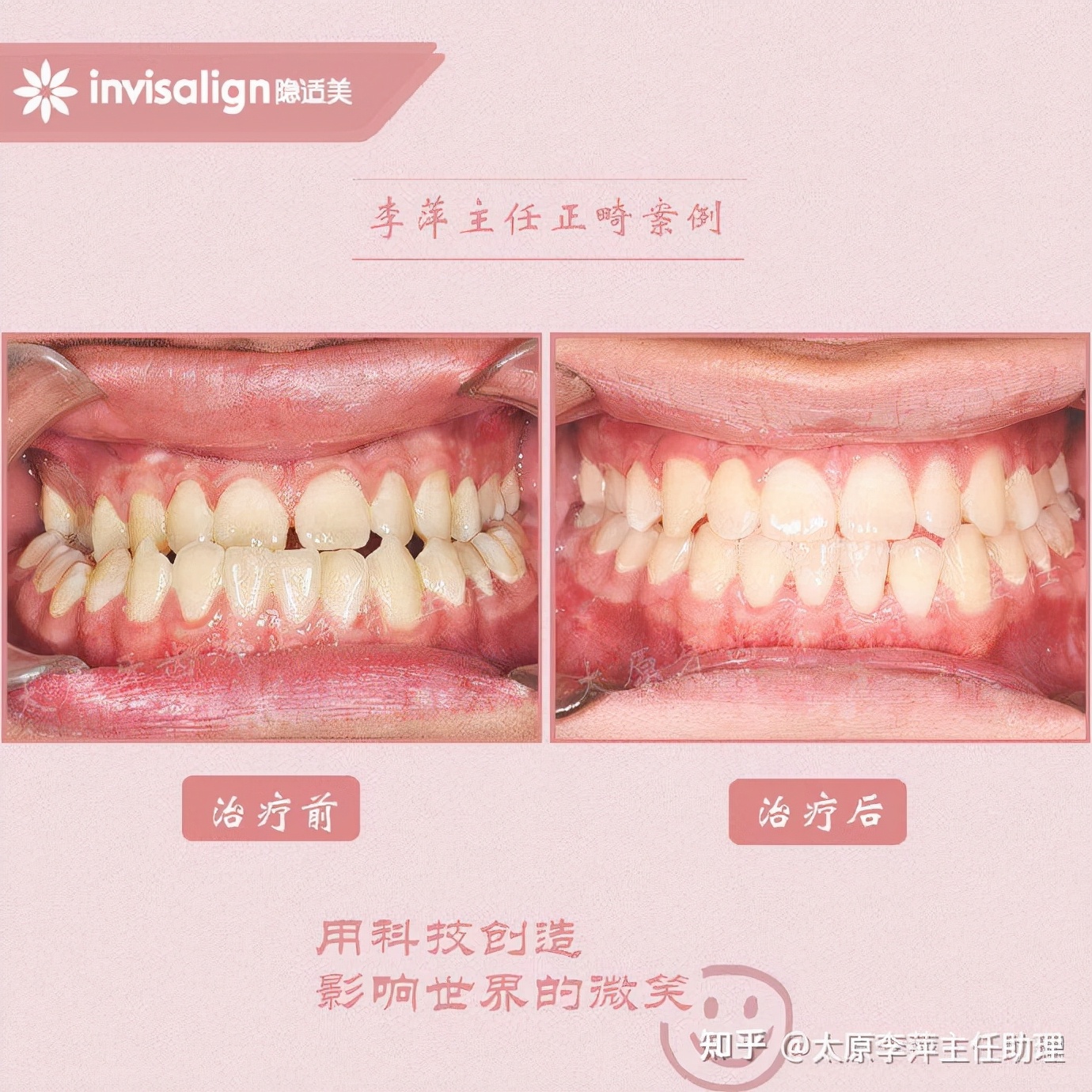 太原矫正牙齿需要做正颌吗,太原牙齿二次矫正