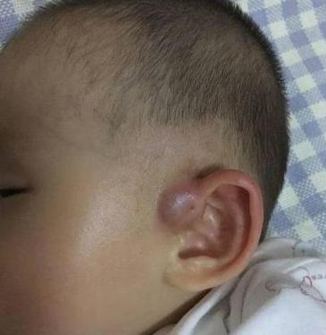 新生儿耳朵有个小孔正常吗,为什么新生儿宝宝耳朵有洞