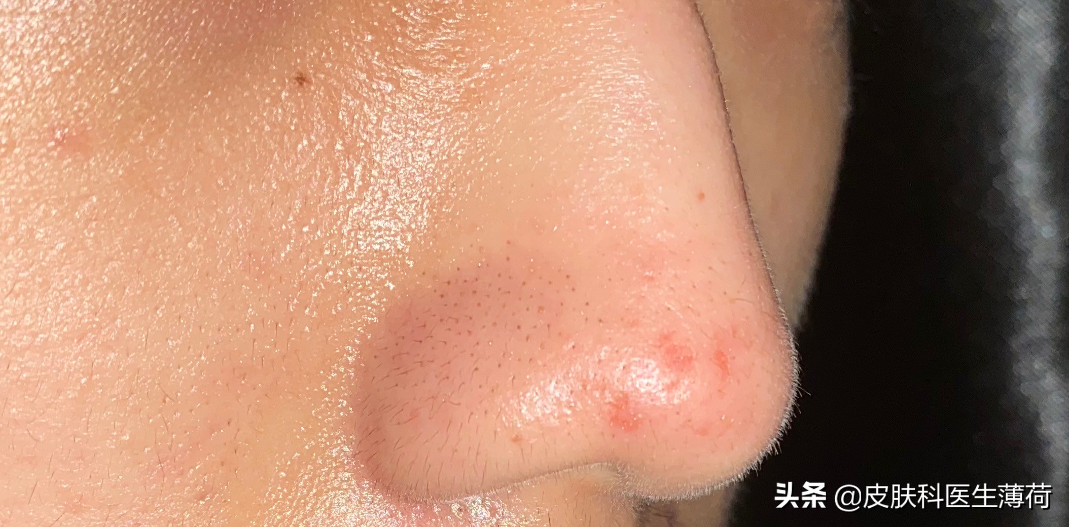 刷酸用果酸还是水杨酸,医生不会告诉你祛脚气的秘密