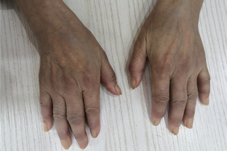 类风湿怎样才算控制住了不再复发,类风湿真的就治不好了吗