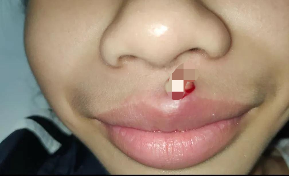 挤痘痘可引起败血症吗,挤痘痘引发的颅内感染能自己好吗