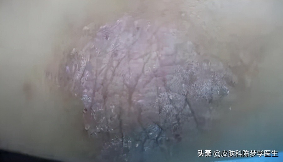 皮肤上长红斑、脱屑，是不是得了牛皮癣？