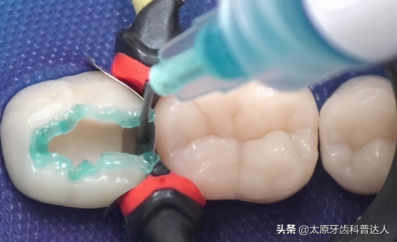 补牙后能吃东西吗,补牙后痛吃消炎药能好吗