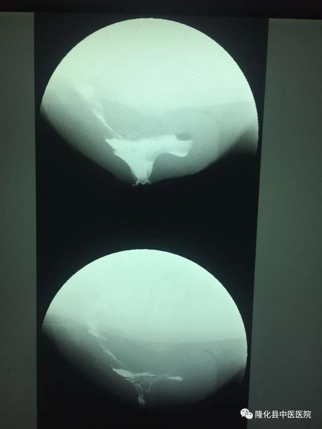 疫情防控和医疗服务两手抓—承德市—隆化县中医院肛肠脾胃病科再添直肠排便造影新技术，填补隆化县空白！