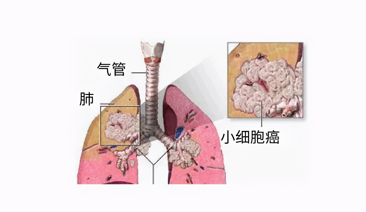 深圳癌症发病率最高的城市,深圳癌症多少例
