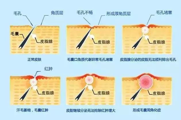 冬天面部角质层薄起皮泛红,换季敏感皮肤泛红脱皮怎么办
