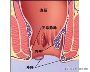 产后痔疮大便出血疼痛怎么办,直肠癌和痔疮大便出血的区别