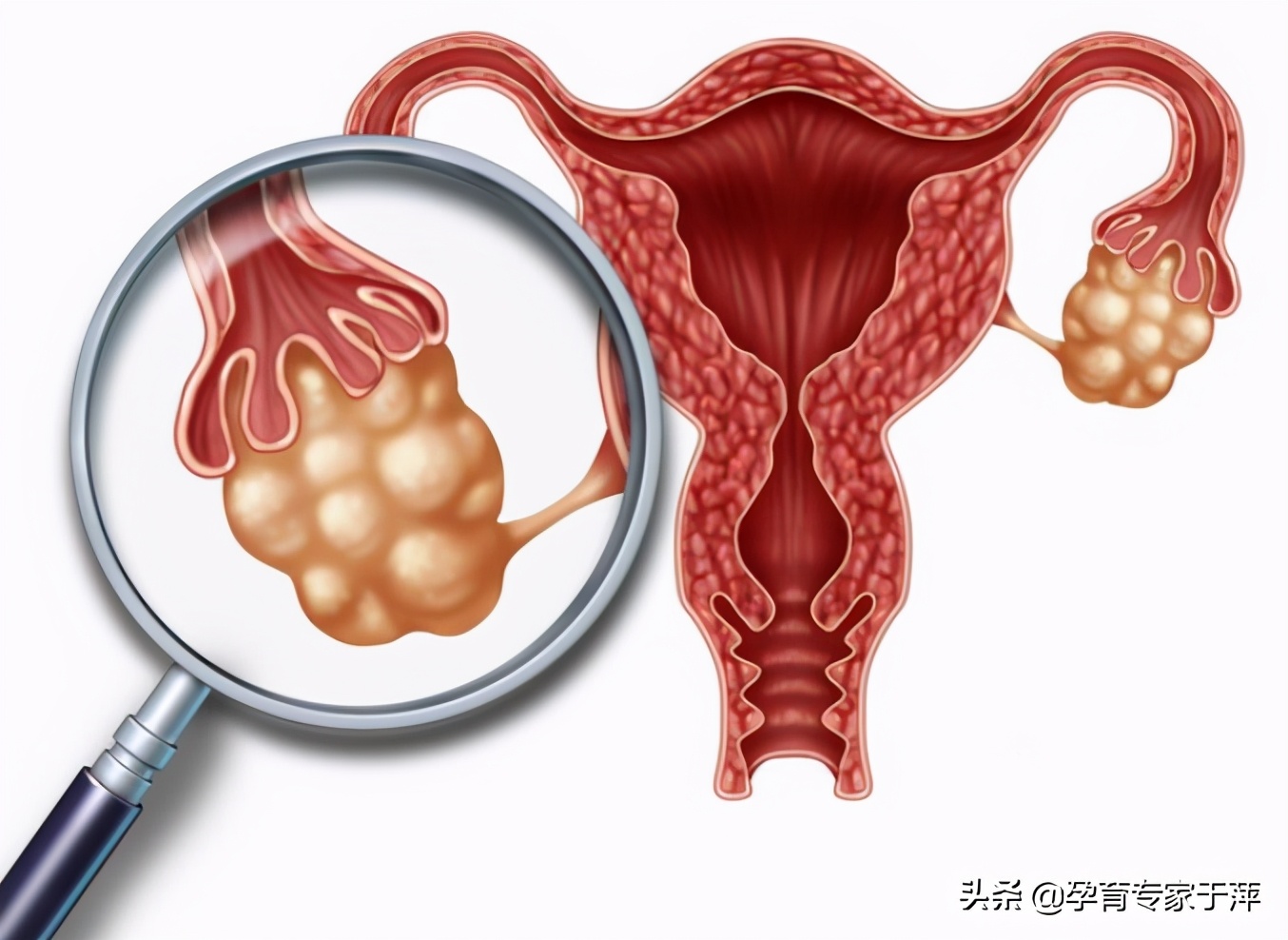 于萍治疗不孕,多囊卵巢综合征的症状和解决