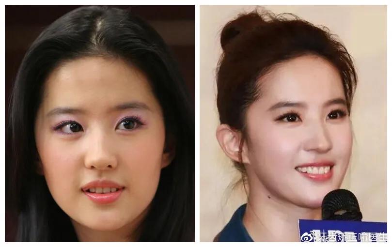 笑起来露牙龈怎么解决,笑露牙龈矫正大概得要多少钱