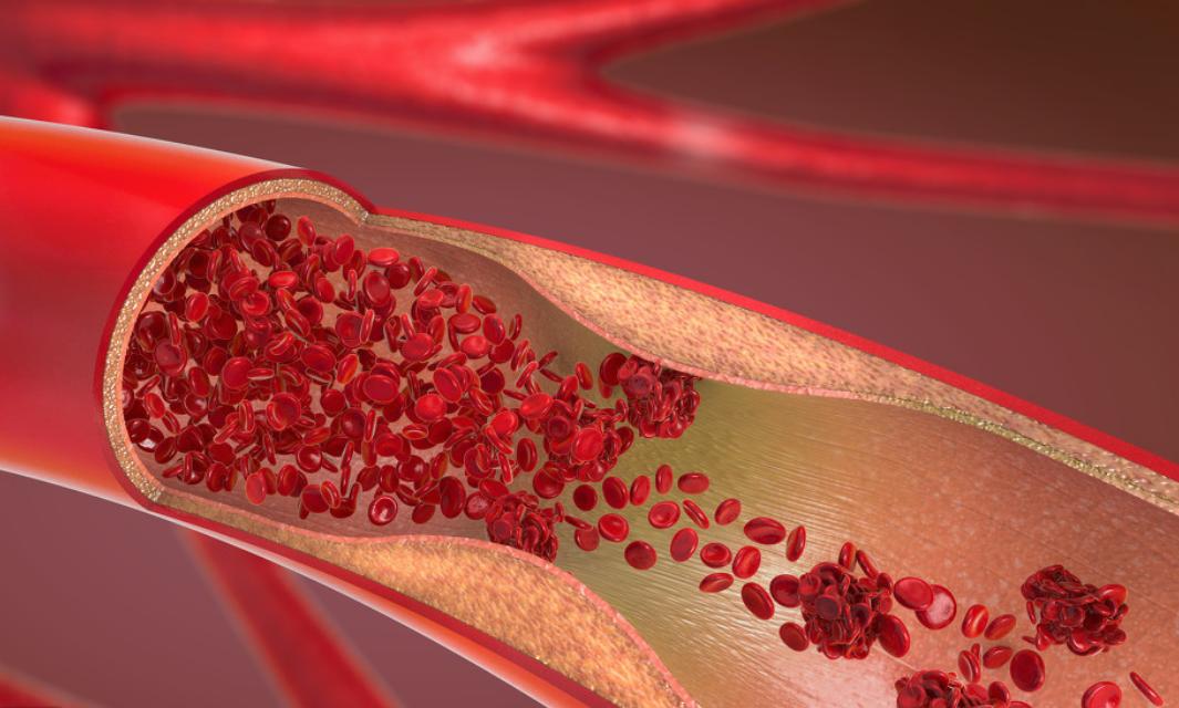 心血管堵塞造影70%需要放支架吗,心血管堵80%怎么症状不明显