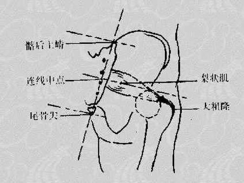 引起腰痛的常见疾病（五）“这些病也可以引起腰痛”