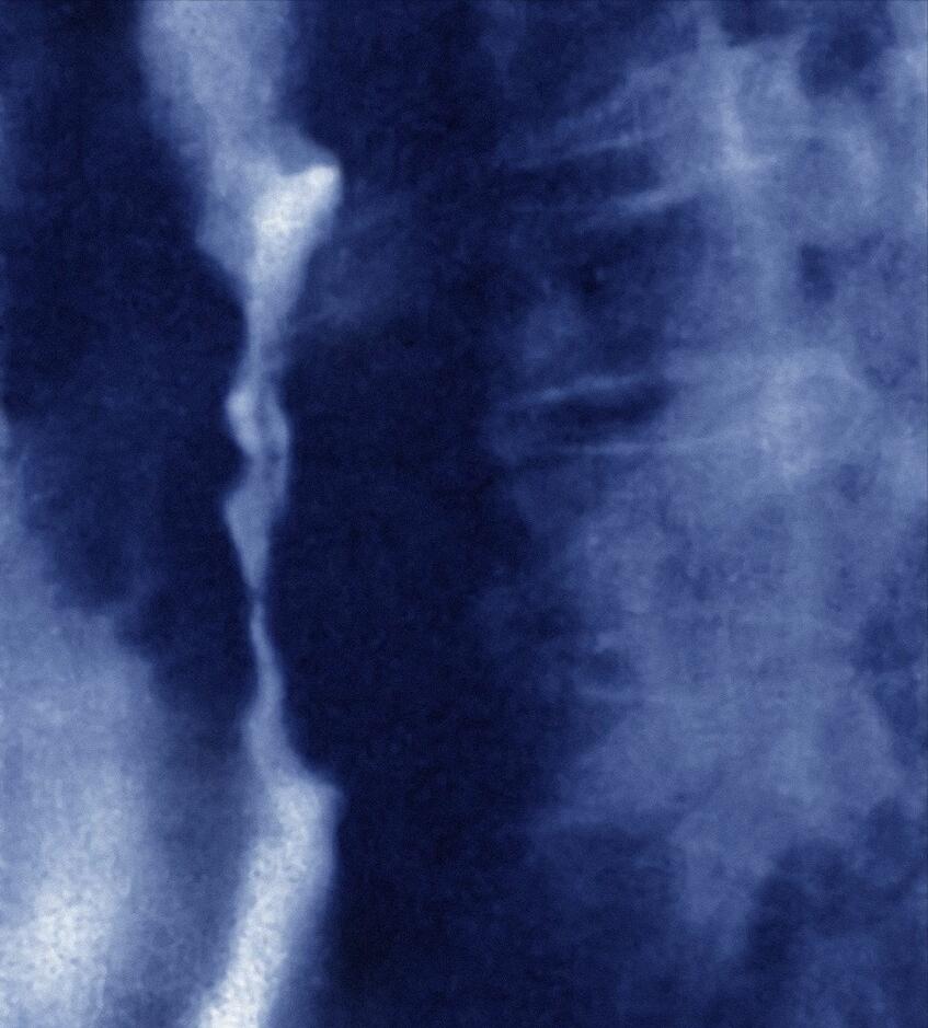 右腰部有点不舒服查出良性肿瘤,腹痛急诊手术意外查出隐匿肿瘤