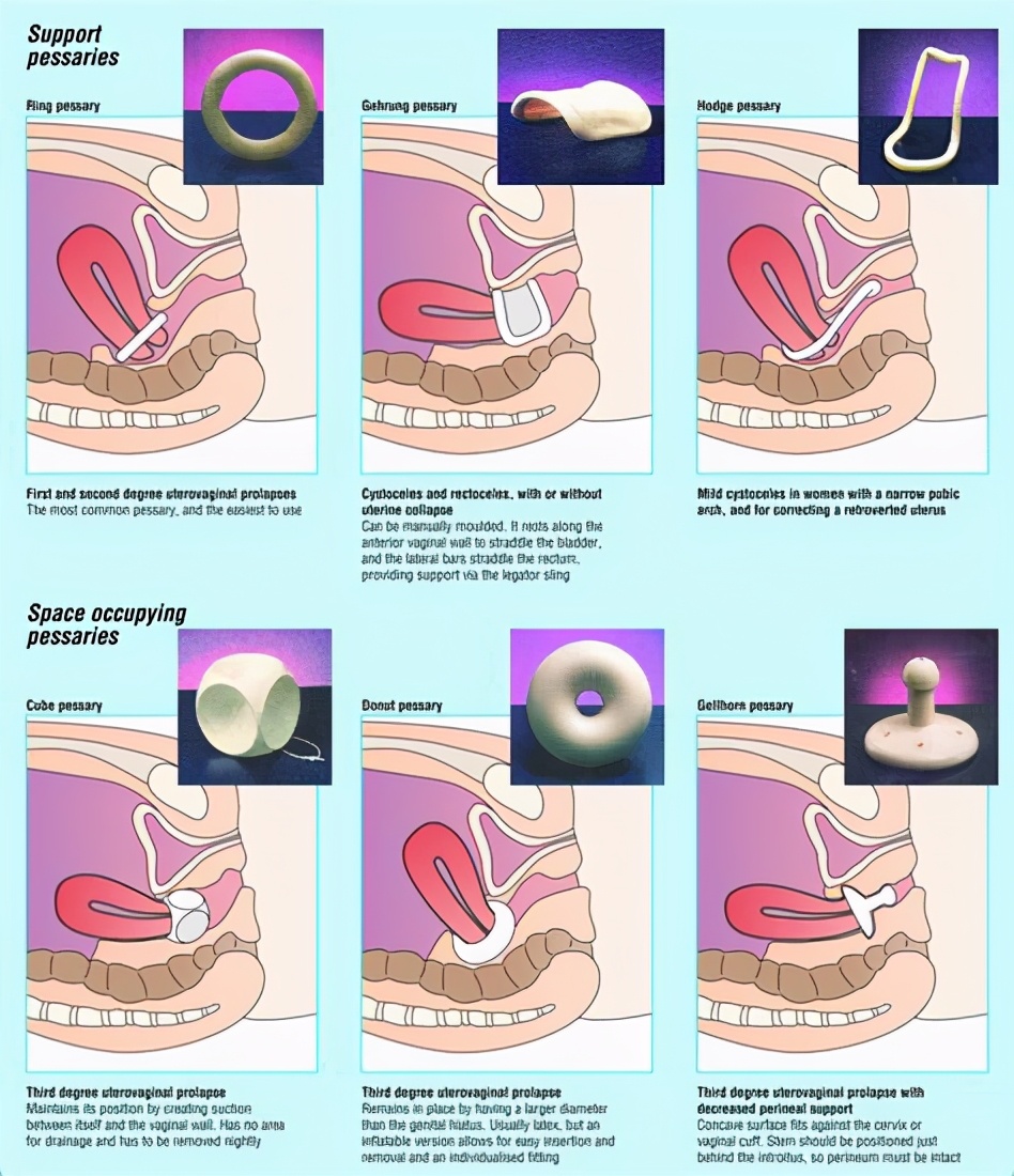 子宫脱垂掉出来了可以做手术吗,子宫有点脱垂可以通过手法复位吗