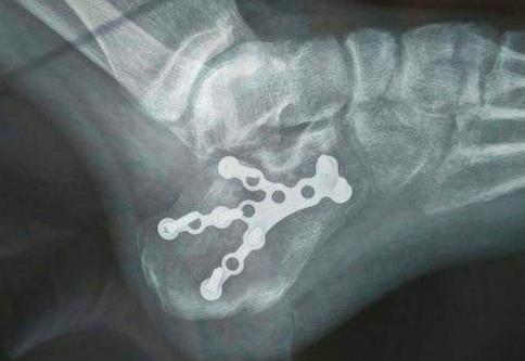 医学科普疑似骨折的正确处理方法,跟骨骨折彻底恢复的概率