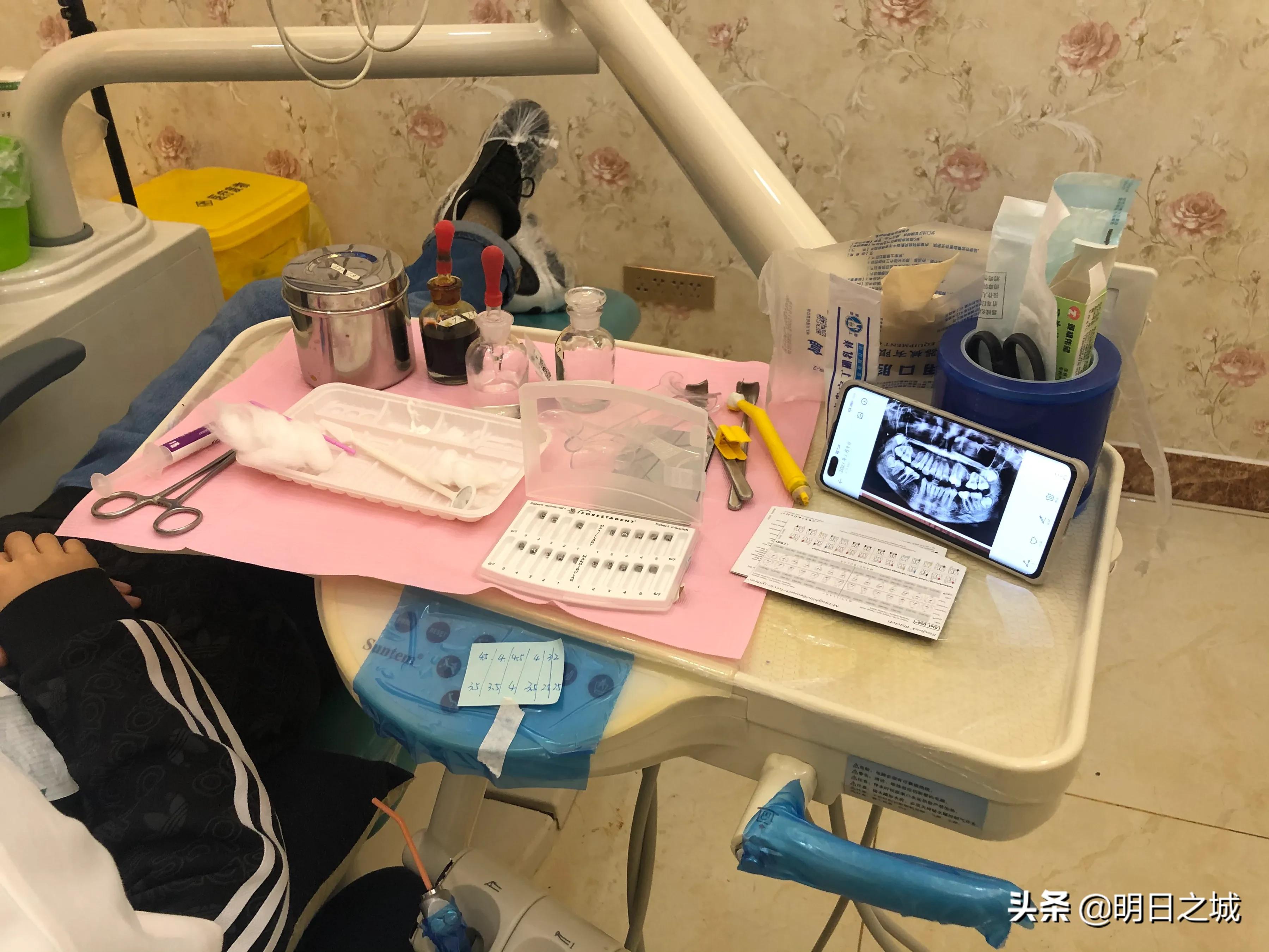 15岁女生矫正牙齿戴牙套全过程,12岁女孩牙齿矫正四颗牙一起拔牙