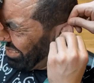 哪种毛适合激光脱毛,最近的激光脱毛