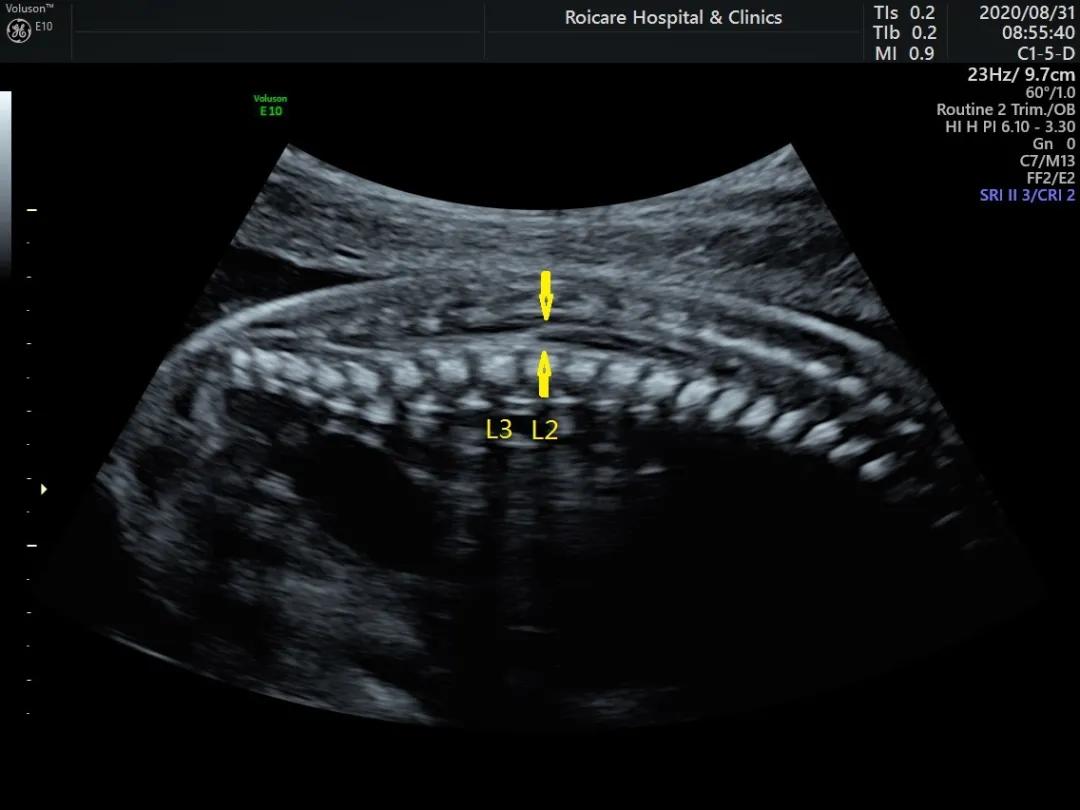 胎儿期发现脊髓圆锥位置低的临床指导