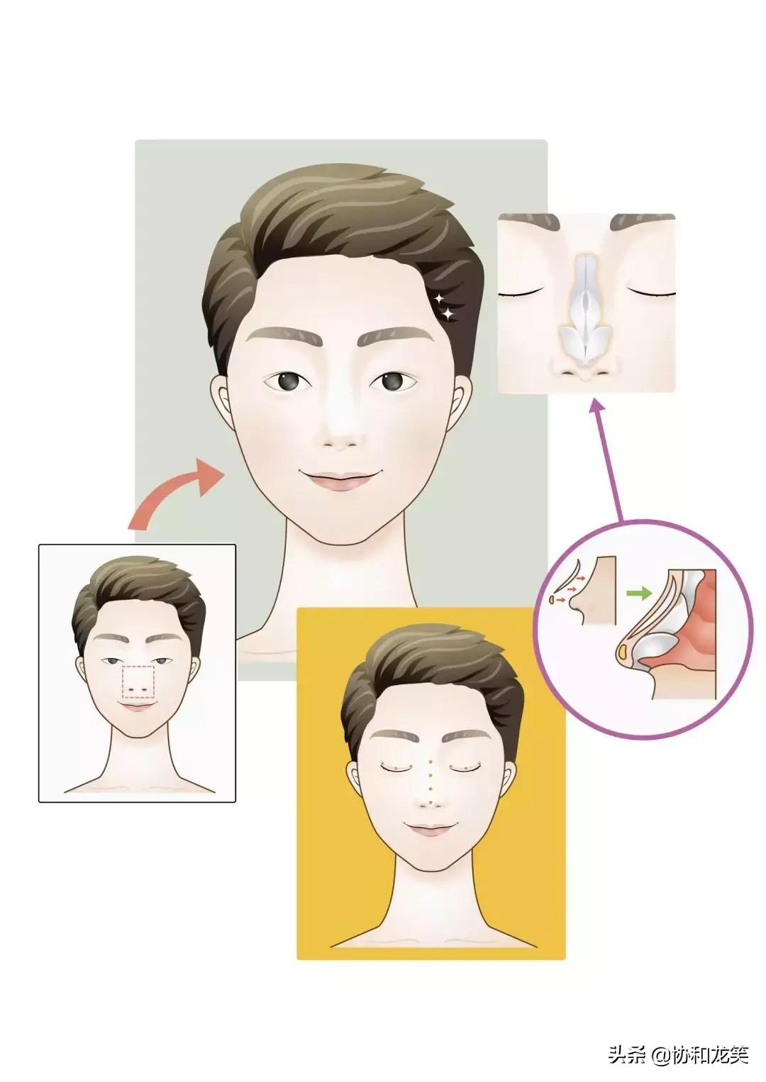 什么是隆鼻术,什么是隆鼻手术