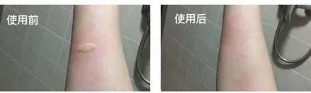 抗痘抑菌凝胶,祥顺比尔霍夫抑菌凝胶治理皮癣