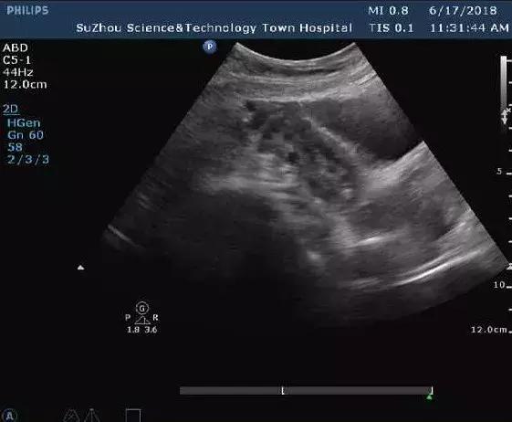 彩超查出卵巢多囊样改变，是不是怀孕就困难了？