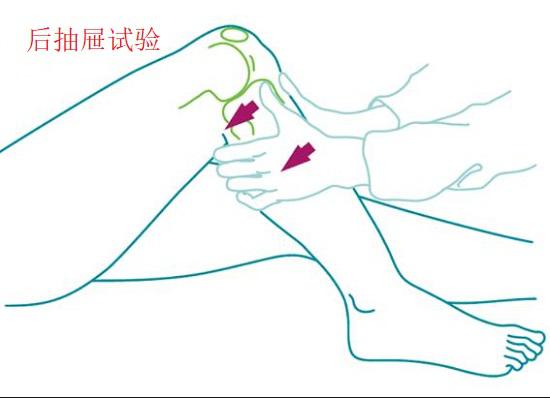 后交叉韧带损伤分什么情况,膝关节前交叉韧带损伤